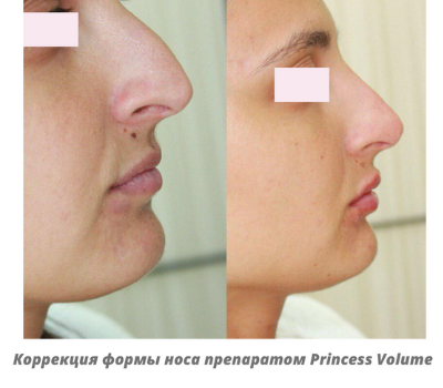 коррекция формы носа спб